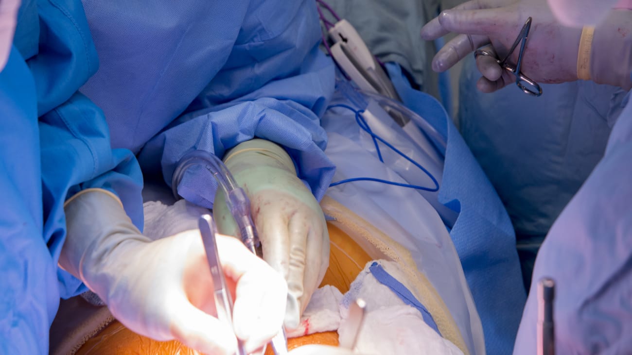 Everything You Needed To Know About Liver Transplants