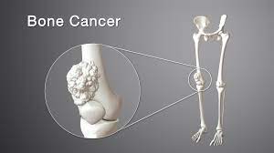 weak bones cancer