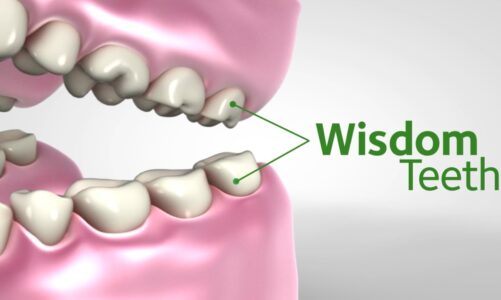 What is wisdom teeth and its Treatment?