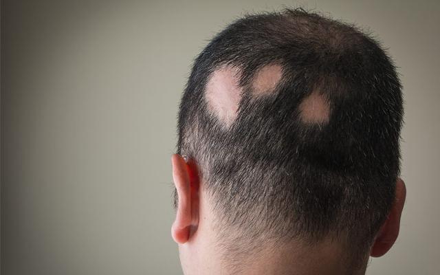 How Can You Prevent Alopecia Areata from Spreading?